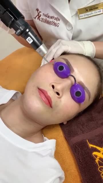 Giải cứu ca trị nám hỏng do điều trị sai phương pháp tại cơ sở khác
