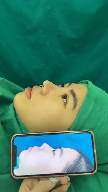 Case mũi cấu trúc sửa lại vừa hoàn thành