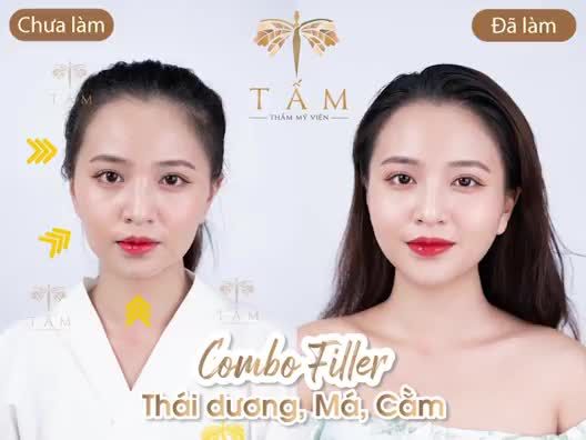 Làm đẹp nhẹ nhàng, giữ trọn nét đẹp tự nhiên cùng combo filler