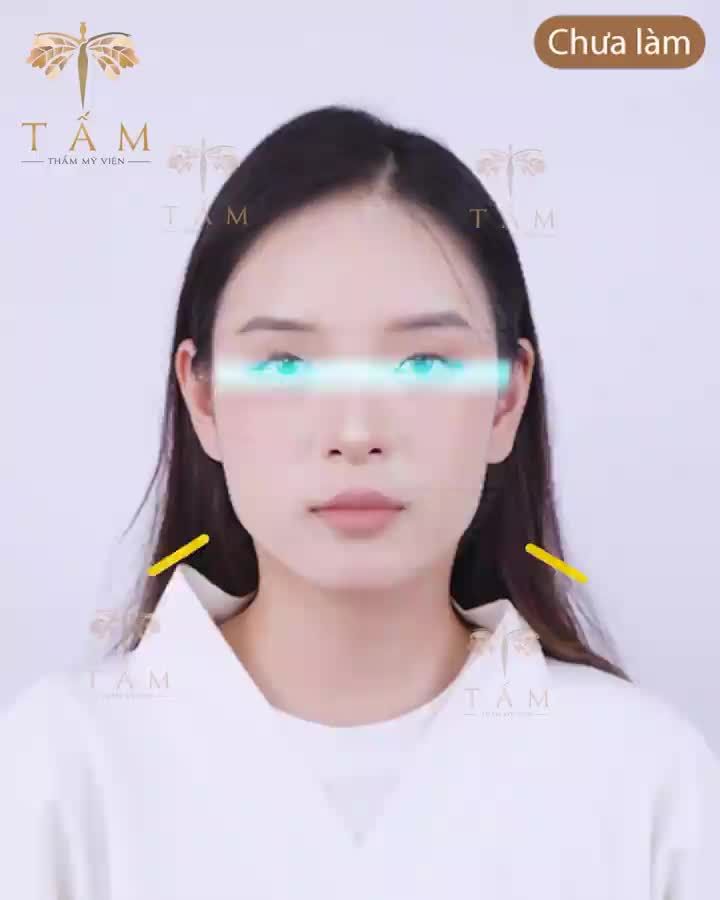 Tạm biệt mặt vuông, khuôn hàm to bạnh khiến gương mặt bạn bị thô kệch, thiếu sự duyên dáng