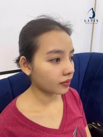 NÂNG MŨI CẤU TRÚC SỬA LẠI - KẾT QUẢ SAU 10 NGÀY