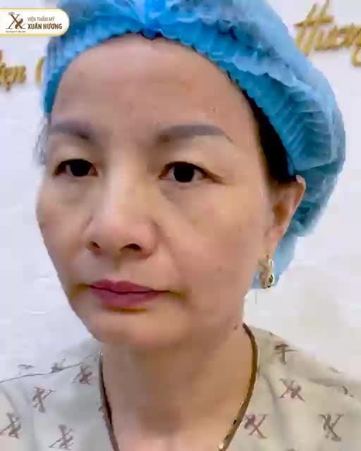 Cung mày chảy xệ Da thừa che cả nếp mí Và màn xử lý xuất sắc từ bác sĩ Quang - VTM Xuân Hương