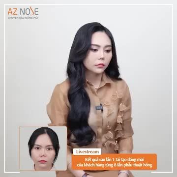 Khách hàng từng phẫu thuật hỏng 8 lần chia sẻ cảm nhận sau 2 tháng tái tạo dáng mũi (lần 1) tại AZ NOSE.