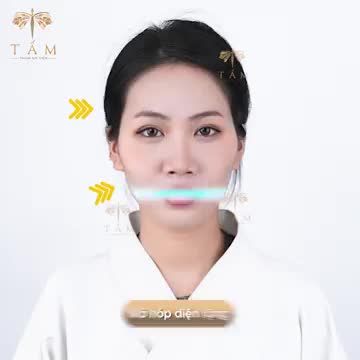 Không cần phải phẫu thuật đau đớn bạn vẫn có thể sở hữu gương mặt hoàn hảo bằng kĩ thuật FILLER đỉnh cao tại Tấm