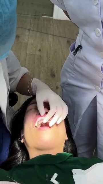 QUÁ TRÌNH THẨM MỸ 12 VENEER SỨ ULTRATHIN