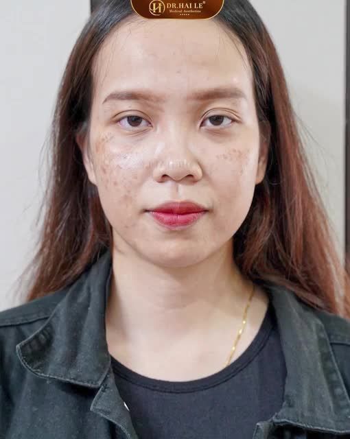 Trước khi thực hiện BMC, vị khách hàng sở hữu làn da nhiều khuyết điểm: Lỗ chân lông to, thâm mụn, tàn nhang, da xỉn màu -Những khuyết điểm này khiến làn da trông thiếu sức sống, bạn gái càng trở nên tự ti.