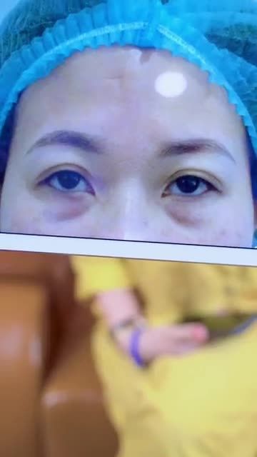 Cắt mí dưới giải pháp vàng giúp đôi mắt trẻ trung thanh thoát
