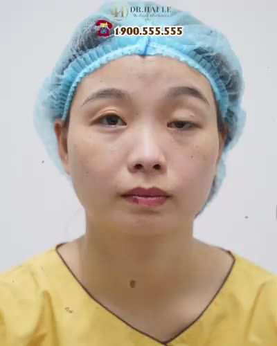 Cảm nhận của vị khách hàng khi sống chung với đôi mắt sụp mí bẩm sinh suốt 25 năm qua.