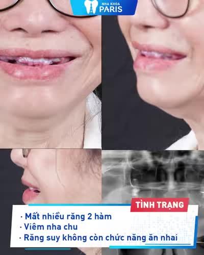 Việt Kiều Pháp Chọn Trồng Răng Chuẩn Pháp