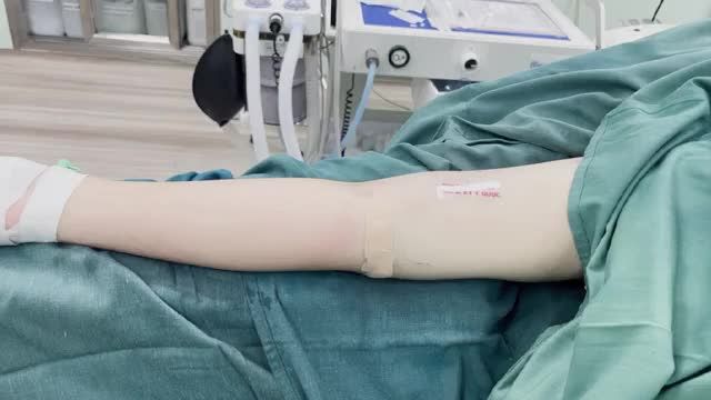 Hút mỡ cánh tay, loại bỏ mỡ thừa. Giúp bạn có thể tự tin diện những bộ trang phục xinh đẹp.