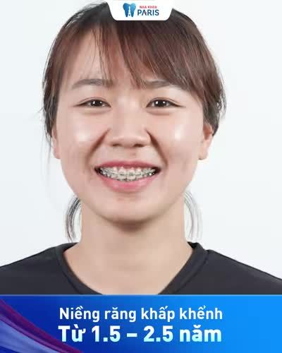 Niềng răng khấp khểnh, rút ngắn thời gian tới 6 tháng