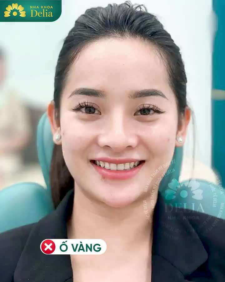 Chị Vân hài lòng chia sẻ: “Em làm răng ở Delia xong ai cũng khen đẹp, nhìn duyên. Em ăn uống rất bình thường mà cảm thấy răng còn khỏe hơn lúc chưa làm nữa cơ”