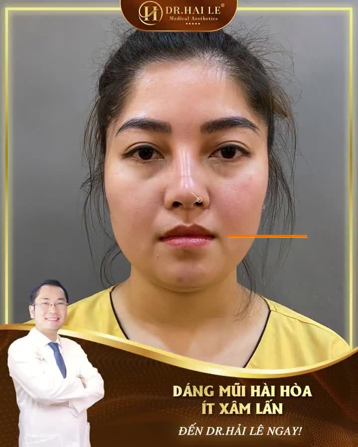Không còn cảm giác tự ti, ngại ngùng khi sở hữu chiếc mũi thấp tẹt, đầu mũi to, thô cứng và cánh mũi xệ, bè sang hai bên.