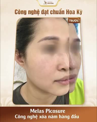 KHI NÀO CẦN ĐI TRỊ NÁM?