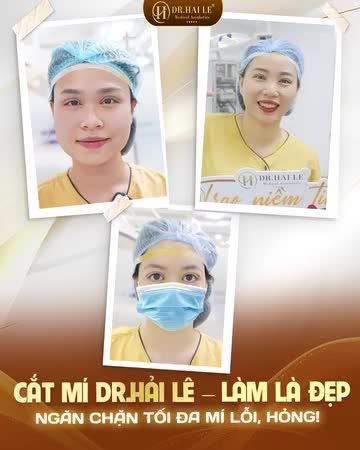 Sở hữu ngay "cửa sổ tâm hồn" đẹp long lanh chỉ sau 60 phút thực hiện - Không tốn nhiều thời gian, nhận lại đôi mắt "đẹp sang".