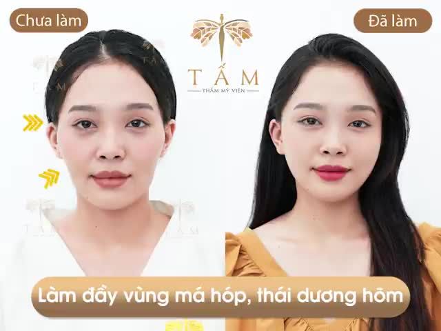 Bạn Thanh Thanh gặp phải tình trạng thái dương hõm, má hóp khiến gương mặt hốc hác, thiếu sức sống.
