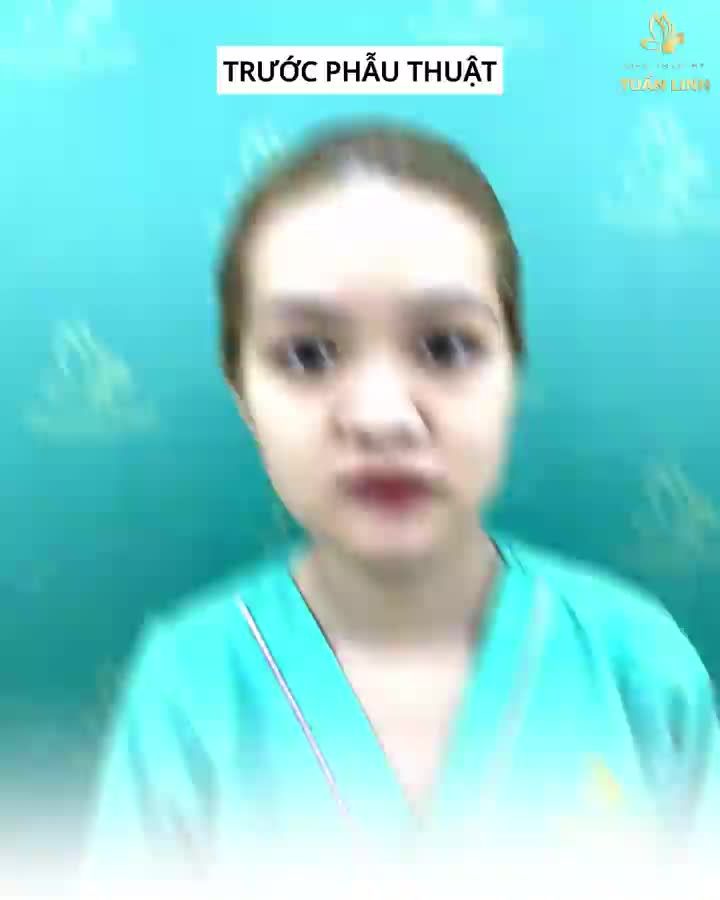 MŨI 15 SẼ NHƯ THẾ NÀO SAU 5