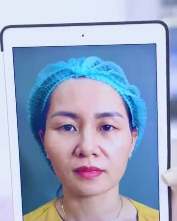 Trẻ ra 10 tuổi chỉ nhờ cắt mí bạn có tin Theo dõi ngay để có câu trả lời bạn nhé