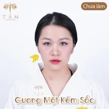 Với lịch trình bận rộn của một mẫu ảnh, bạn Thanh Trúc đã lựa chọn filler tại Tấm để khắc phục các khuyết điểm trên gương mặt mà không làm ảnh hưởng đến công việc.