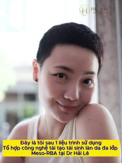 MC Huyền Linh đã thay đổi như thế nào sau 1 Liệu trình sử dụng: TỔ HỢP CÔNG NGHỆ TRỊ LIỆU TÁI TẠO TÁI SINH LÀN DA ĐA LỚP MESO-RBA tại Dr.Hải Lê?