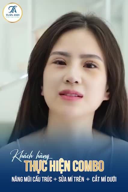 Thành quả ca thực hiện combo nâng mũi cấu trúc + sửa mí trên + cắt mí dưới của chị khách hàng đến từ Hà Nội sau 7 ngày cắt chỉ.