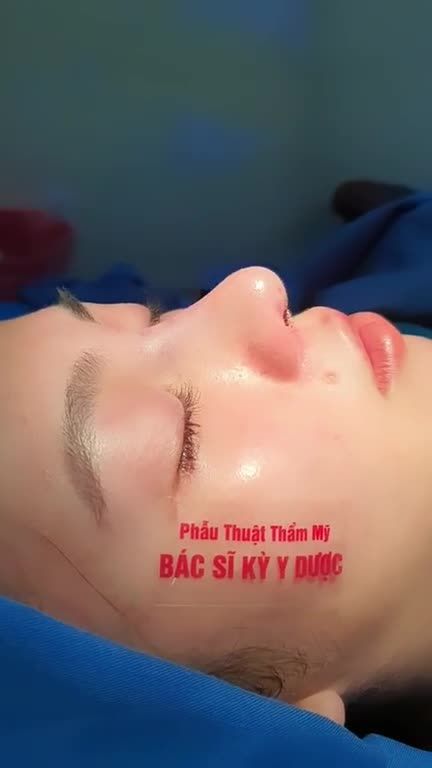 CẢI THIỆN HOÀN TOÀN DÁNG MŨI VỚI NÂNG MŨI ALINE