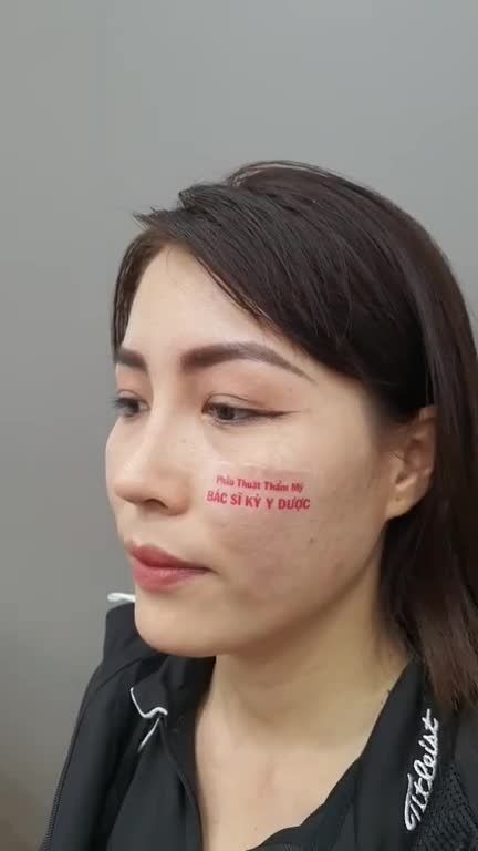 Chị khách đến tái khám sau 1 tháng Nâng Mũi ALINE Bán Cấu Trúc Đa Lớp.