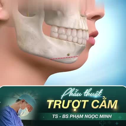 MÔ PHỎNG PHẪU THUẬT TRƯỢT CẰM