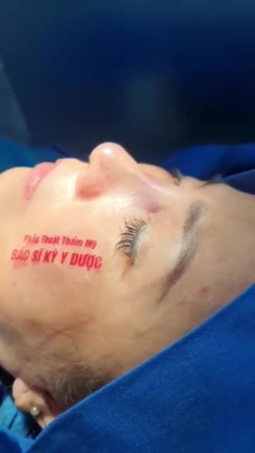 Dáng Mũi ALINE cao bay tự nhiên, hài hòa với khuôn mặt