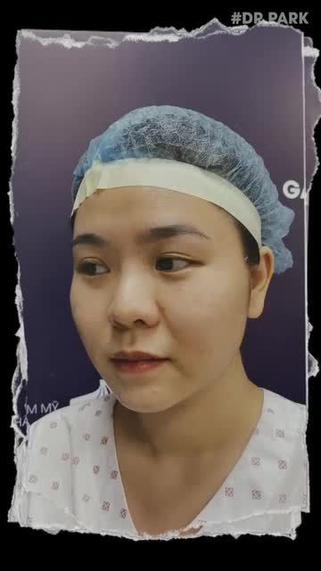 BẠN CẦN TRÁNH GÌ TRONG 14 NGÀY VÀNG SAU NÂNG MŨI?