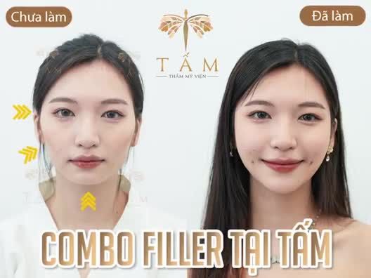 Lý do khiến khách hàng lựa chọn combo filler để làm đẹp khi đến Tấm: