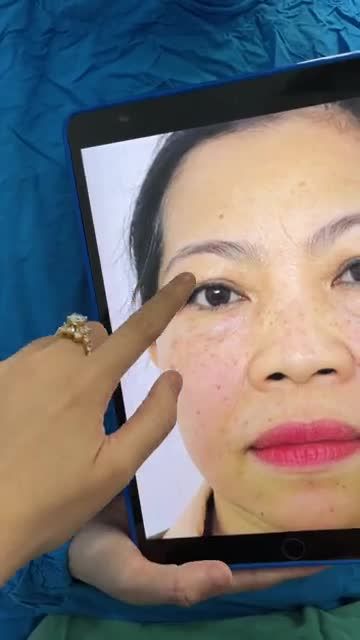 VỪA XONG CA TẠO HÌNH MÍ TRÊN- MÍ DƯỚI CHO CÔ KHÁCH "SỢ ĐAU"