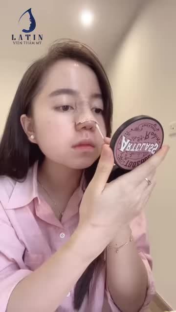 Kết quả nâng mũi sau 10 ngày của HOT TIKTOKER