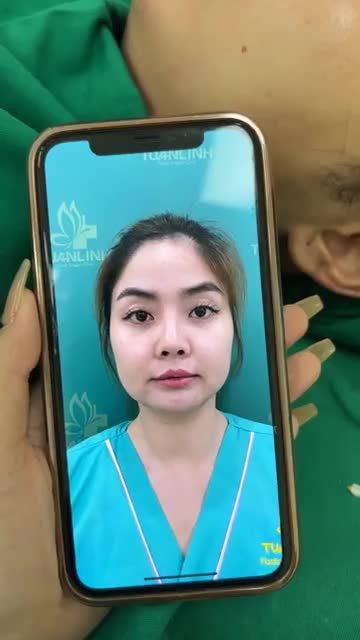 Case mũi cấu trúc sửa lại + độn cằm vừa hoàn thành