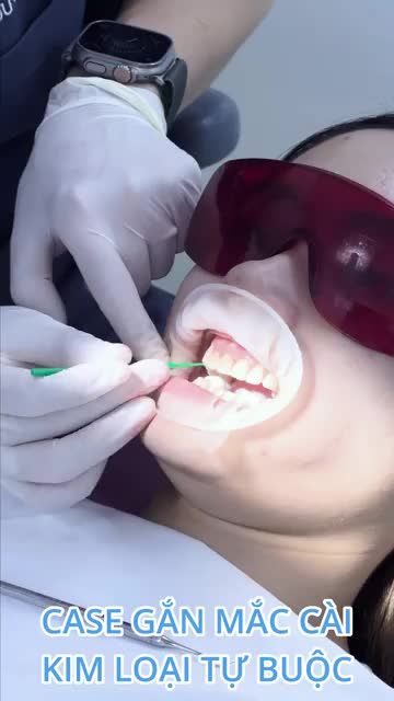 Tiến hành gắn mắc cài hàm trên cho bạn Hồ Thu Phương trong buổi đầu tiên tại nha khoa quốc tế Việt Mỹ.