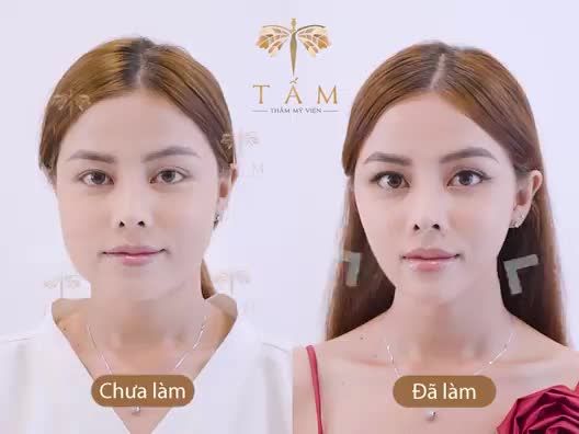 CÁCH NHANH NHẤT GIÚP CHỊ KIM HOA SỞ HỮU GƯƠNG MẶT VLINE