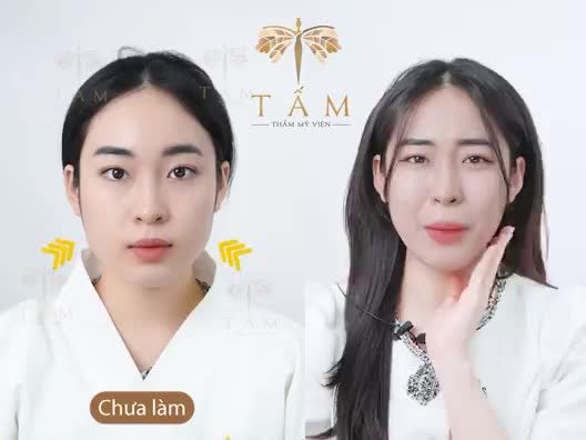 Muốn mặt chuẩn Vline mà không xâm lấn thì chỉ có VLINE PERFECT thôi