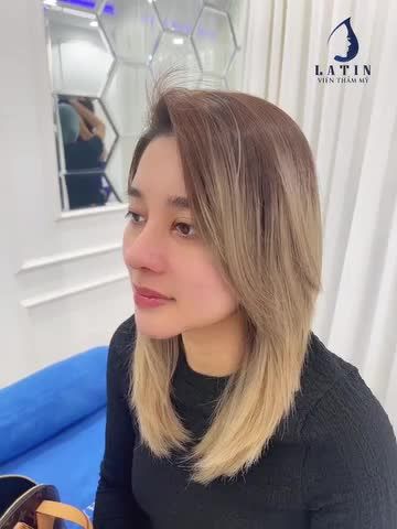 Combo mũi tái cấu trúc sửa lại + độn cằm sụn Mỹ sau 10 ngày