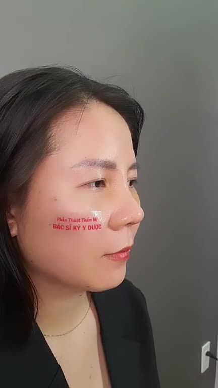 Nhờ đôi bàn tay khéo léo của Bác sĩ Kỳ Y Dược, chỉ sau 6 ngày Nâng mũi ALINE + Treo Cánh Mũi. Chị khách đã sở hữu: