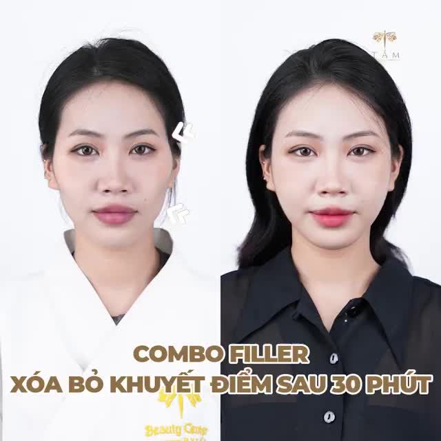 Bạn mong muốn: - Sở hữu gương mặt đầy đặn, tươi trẻ - Đường nét hài hòa, tự nhiên. - Sở hữu má baby tràn đầy sức sống