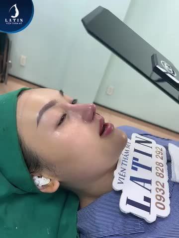 Mũi đã nâng 8 năm, sửa lại có đẹp không?
