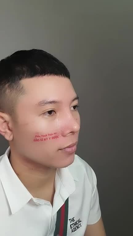 Dáng mũi ALINE - hoàn thiện vẻ nam tính.