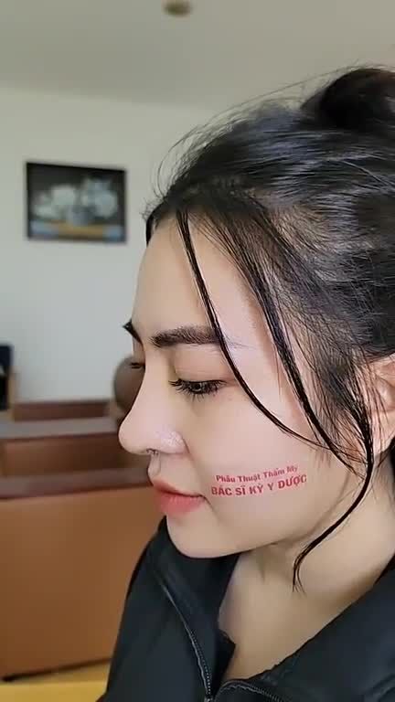 Lấy lại tự tin sau 8 ngày Nâng Mũi ALINE do chính tay Bác sĩ Kỳ Y Dược thực hiện.