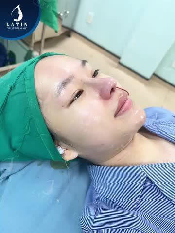 Mũi cấu trúc đẹp ngay sau khi làm cho em gái Việt kiều Úc