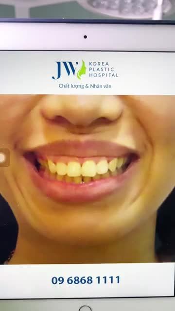 CẮT 2 HÀM ĐẨY LÙI VỀ SAU chị gái 9X hạnh phúc vỡ òa vì MẤT HÀM HÔ sau 30 năm