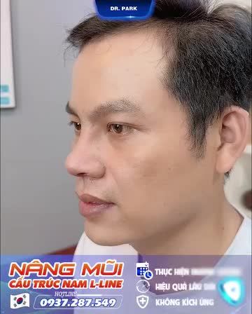 NAM GIỚI THƯỜNG GẶP KHUYẾT ĐIỂM MŨI NHƯ THẾ NÀO?