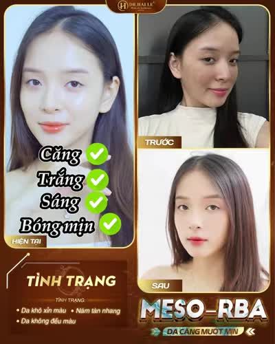 Chỉ với 1 liệu trình Cấy Meso RBS tại Dr Hải Lê , da xấu xí đến mấy cũng cải thiện thành làn da xinh, bật vẻ đẹp lung linh!