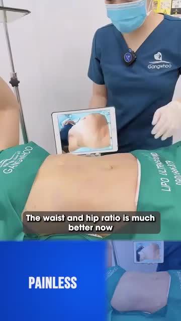 BẠN MUỐN XÓA MỠ BỤNG - HÃY CHỌN LIPO ULTRASOUND