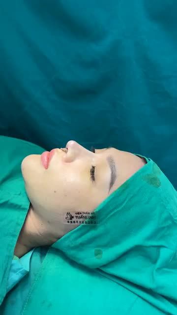 Case mũi cấu trúc sửa lại vừa hoàn thành