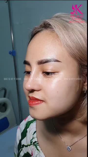 Tái khám nâng mũi ALINE sau 13 ngày tại cơ sở Nha Trang
